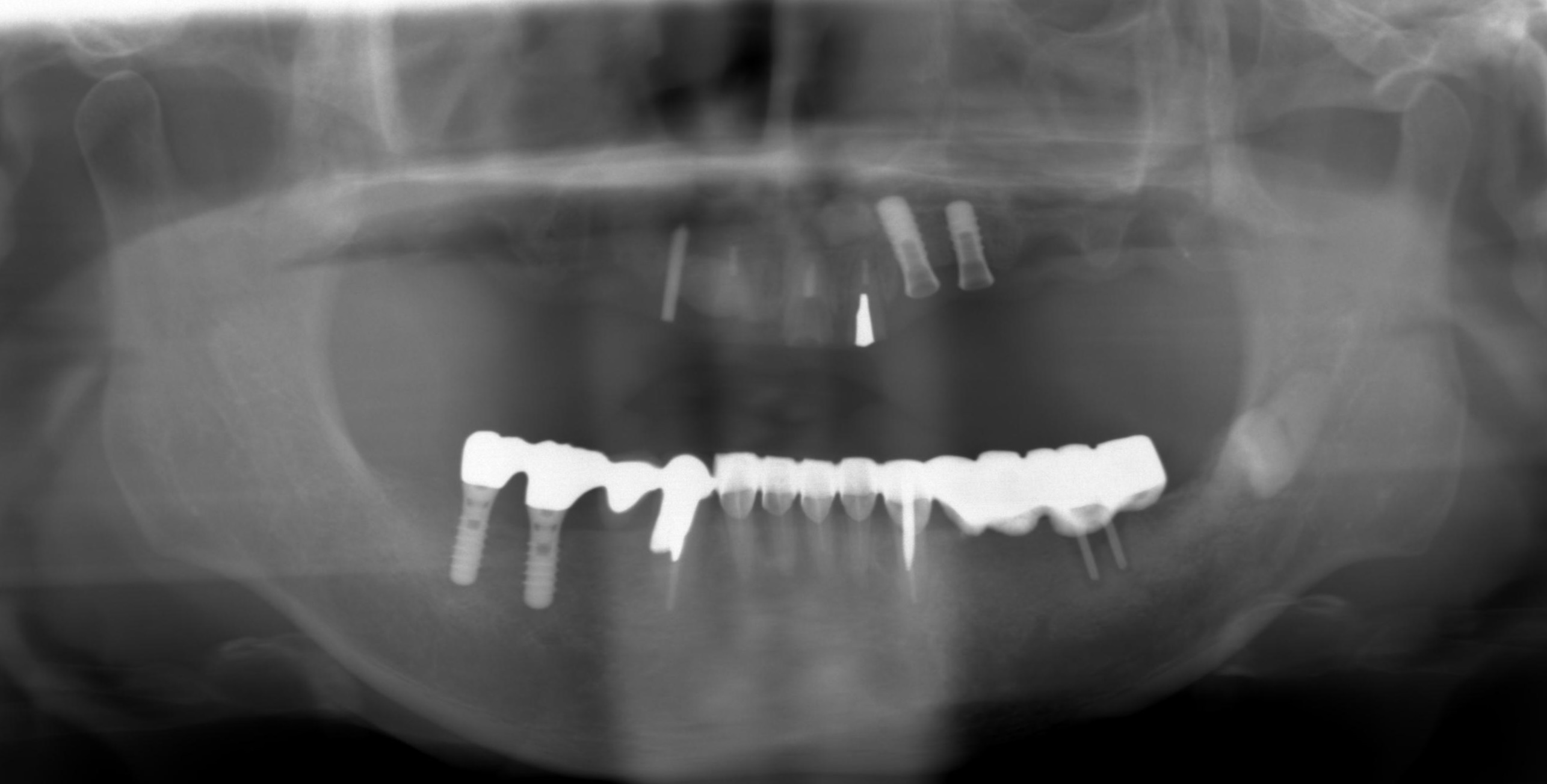 重度の歯周病からインプラントへのビフォーアフター2