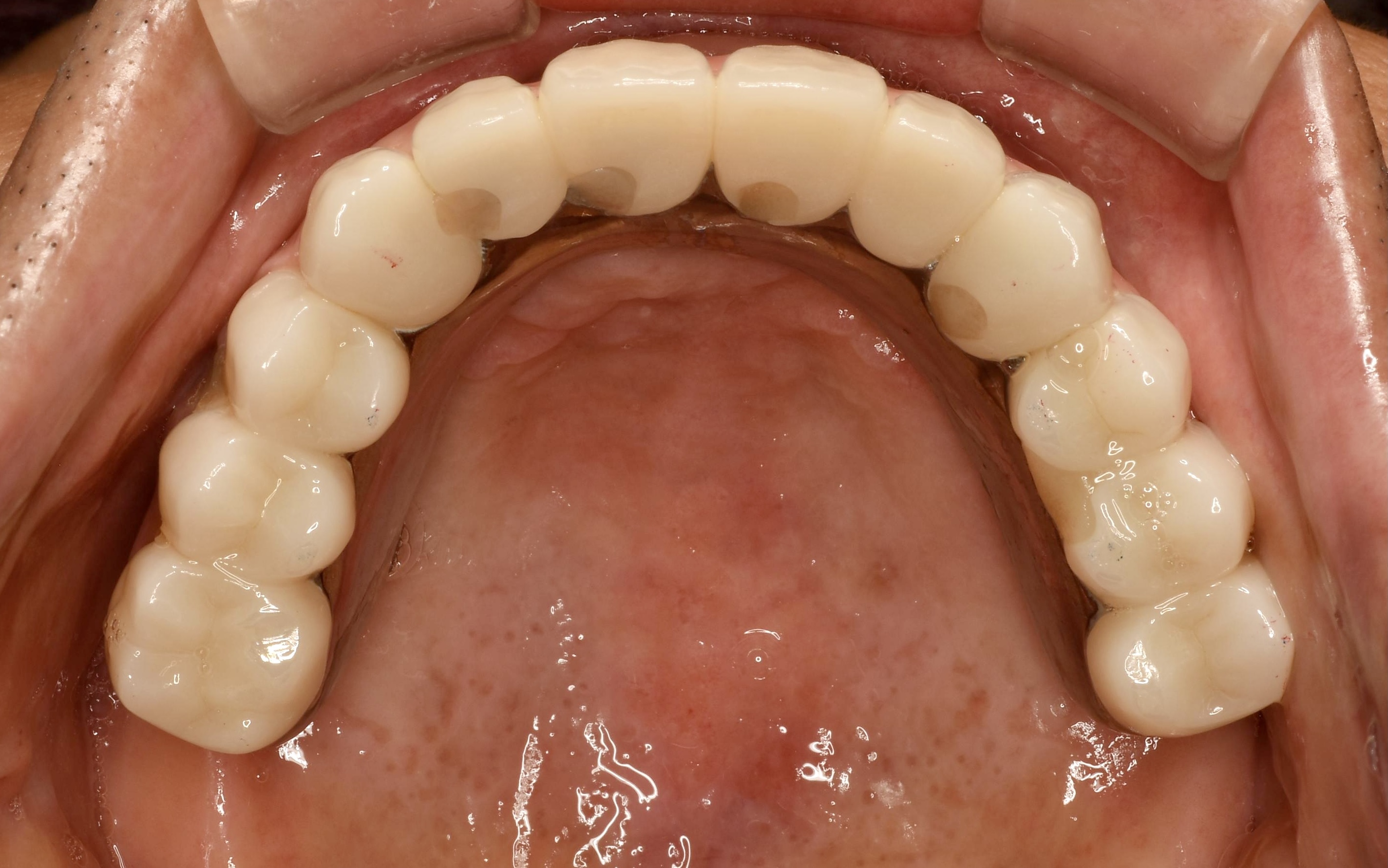 重度の歯周病からインプラントへのビフォーアフター4