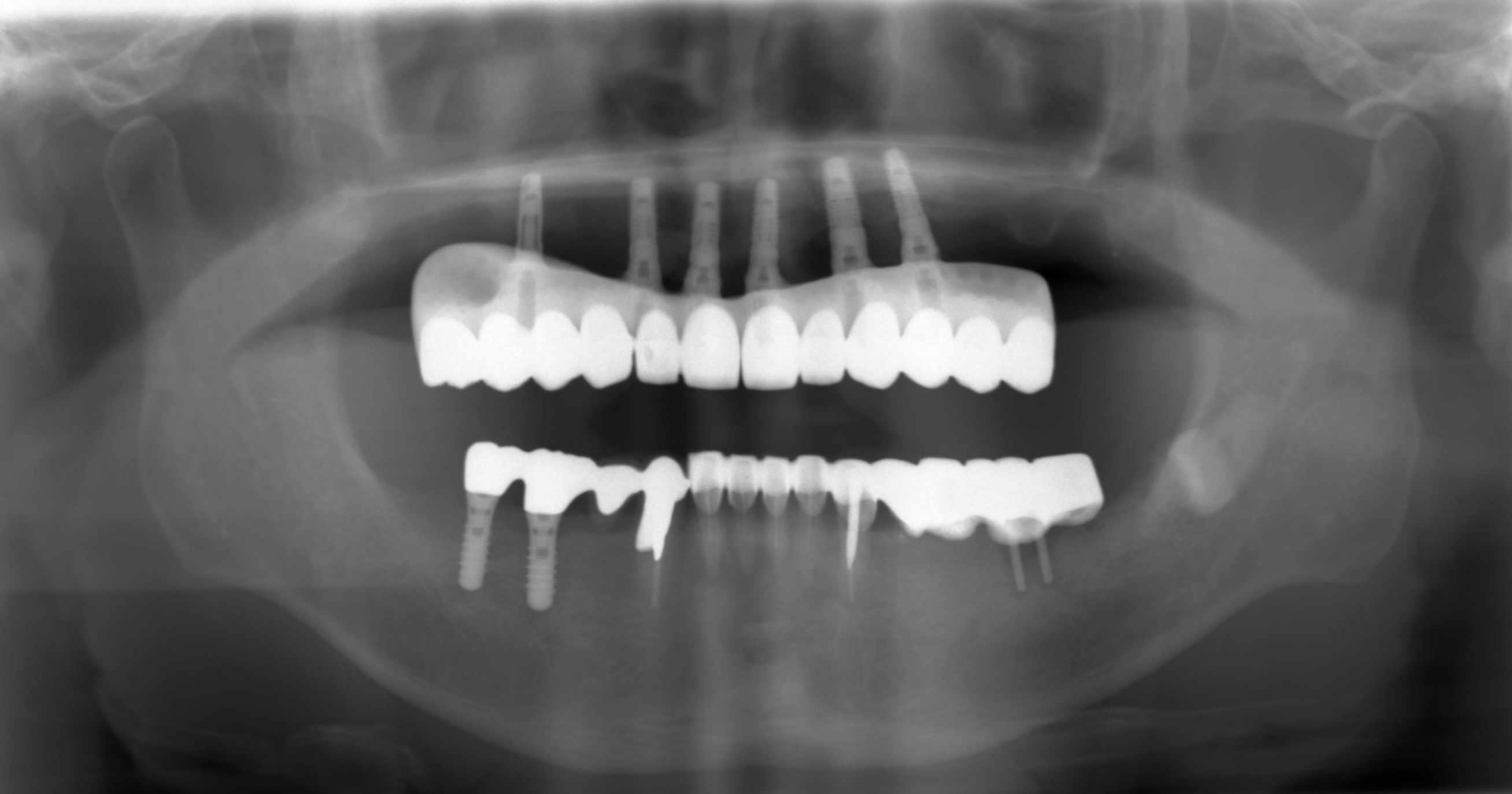 重度の歯周病からインプラントへのビフォーアフター1