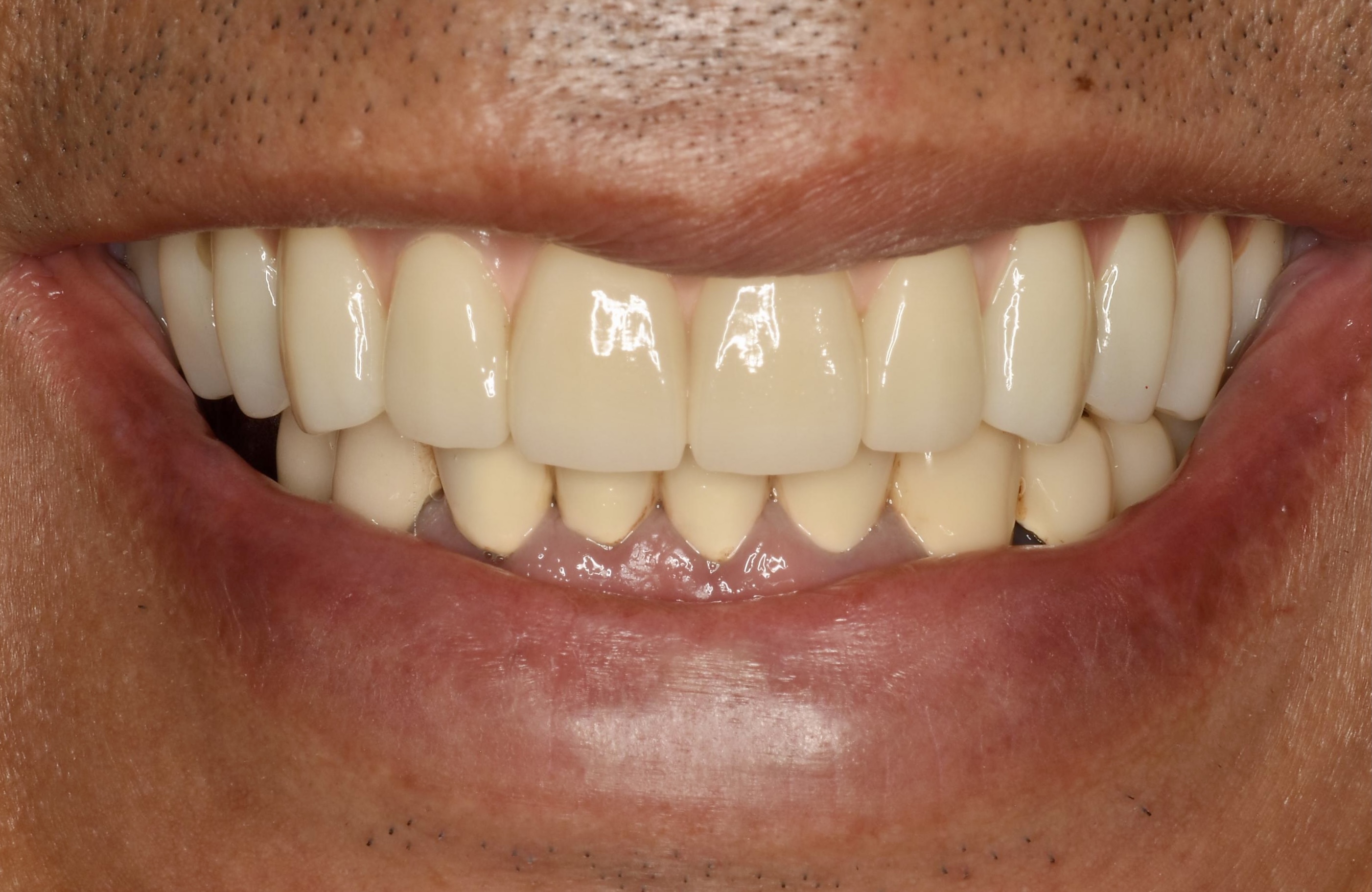 重度の歯周病からインプラントへのビフォーアフター3