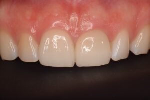 前歯のラミネートベニア・オールセラミッククラウンの症例（拡大）