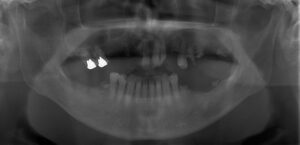 歯がない・無歯顎のインプラント症例 レントゲン写真（ビフォー）