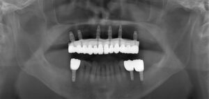 歯がない・無歯顎のインプラント症例 レントゲン写真（アフター）