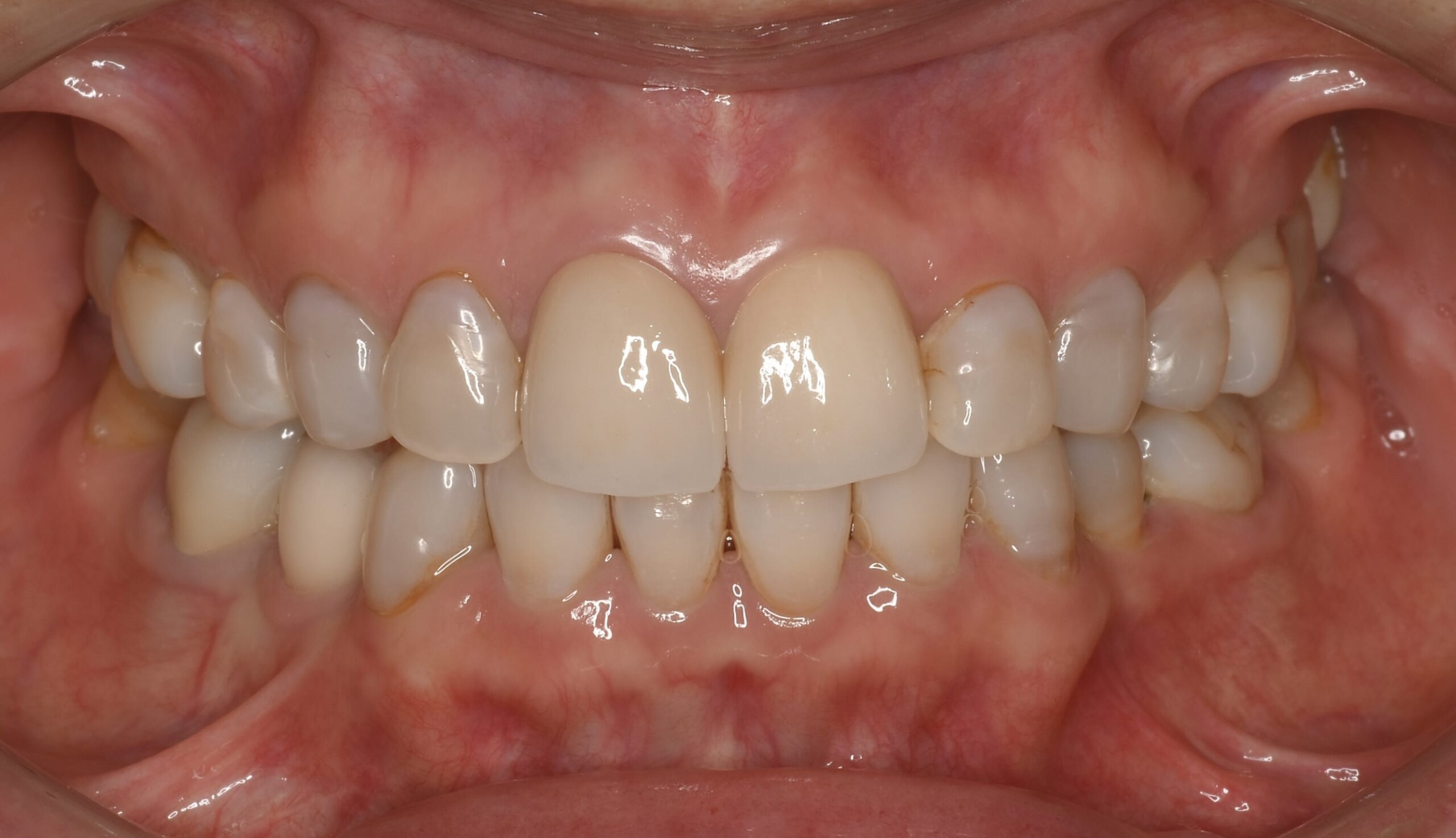前歯の抜歯即時インプラント 海外の患者